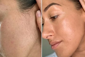 best hair removal laser in karachi