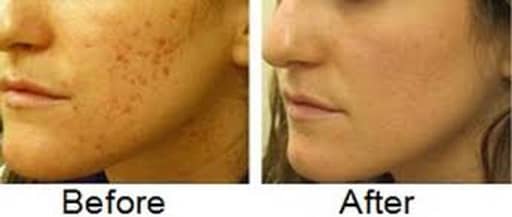 ice pick scars