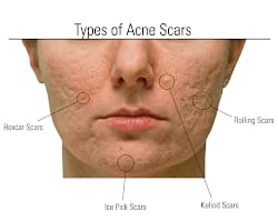 Boxcar scars