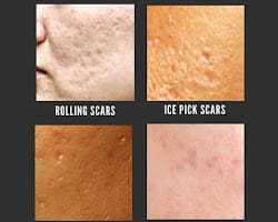 rolling scars