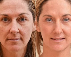 Laser Resurfacing